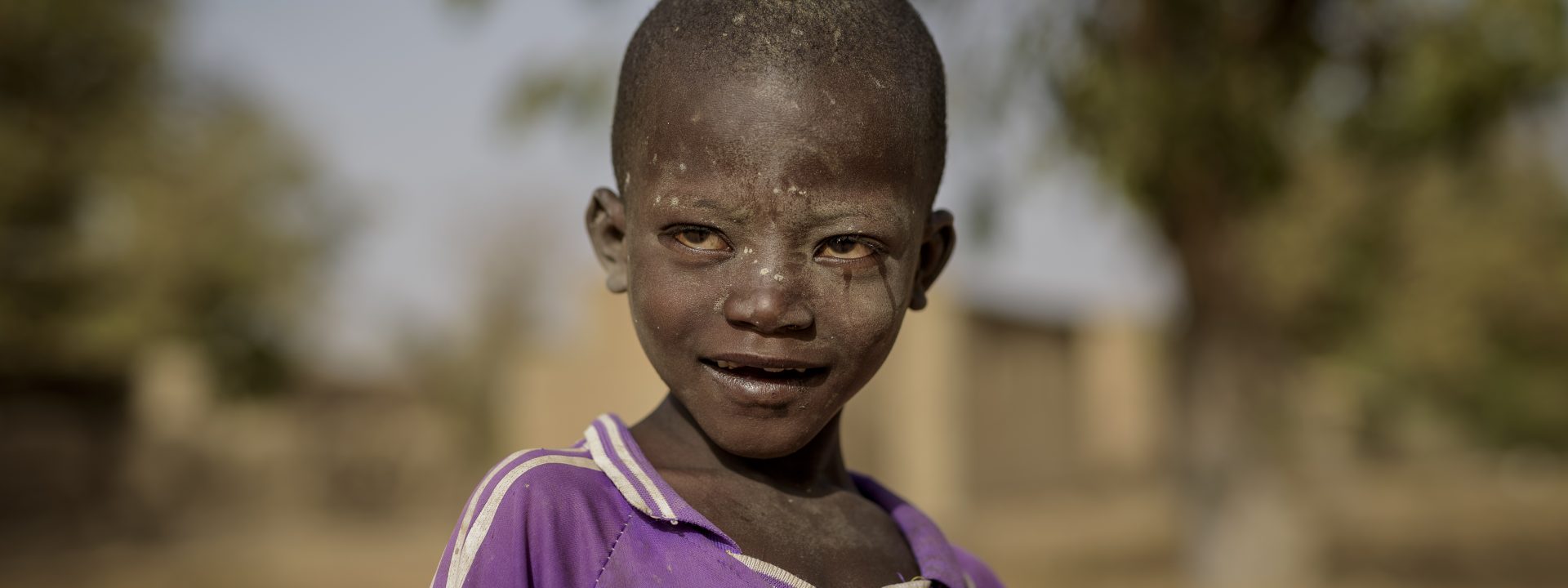 Water, sanitation and hygiene against blindness